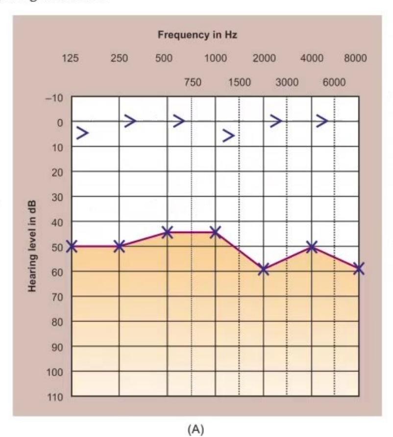 images/MNJ-P-OSCE 06. Audiometry, capnogram, spirometry_page_4_Figure_5.jpeg