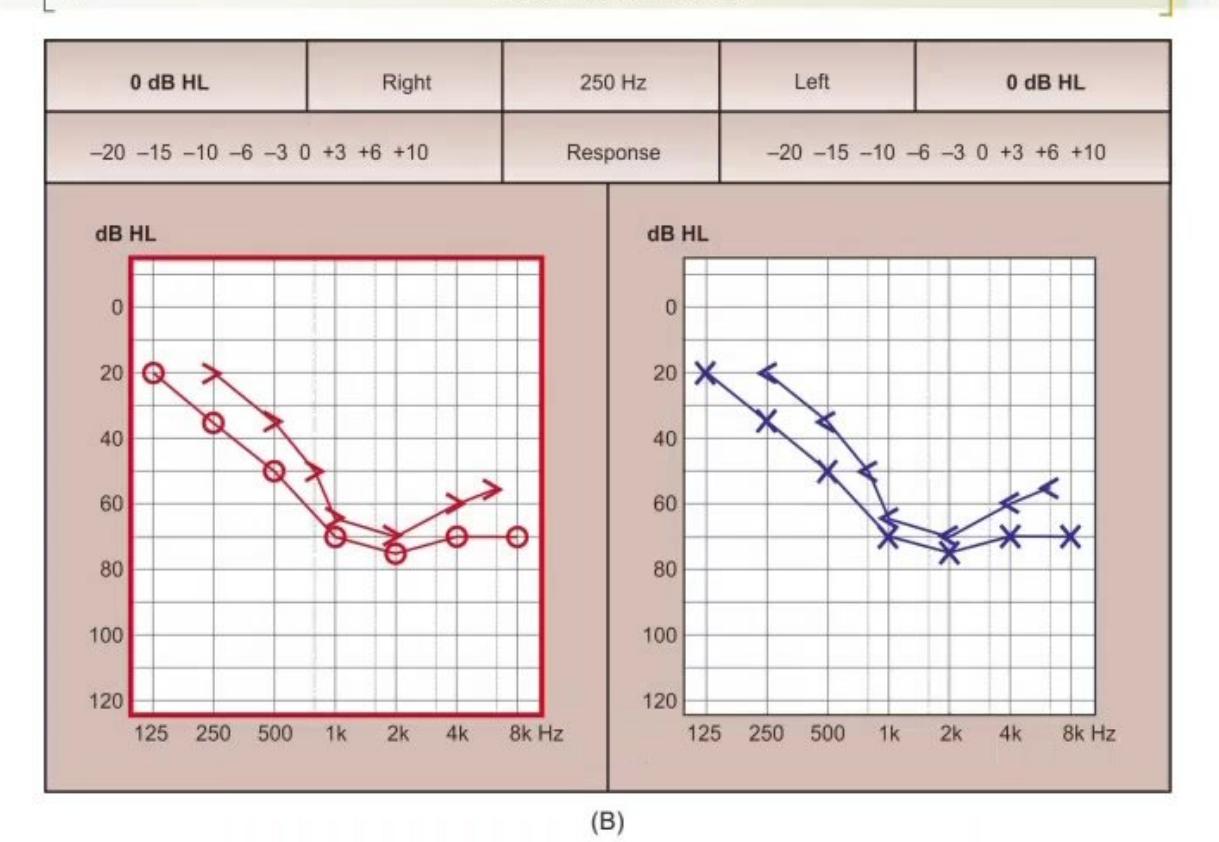 images/MNJ-P-OSCE 06. Audiometry, capnogram, spirometry_page_5_Figure_2.jpeg