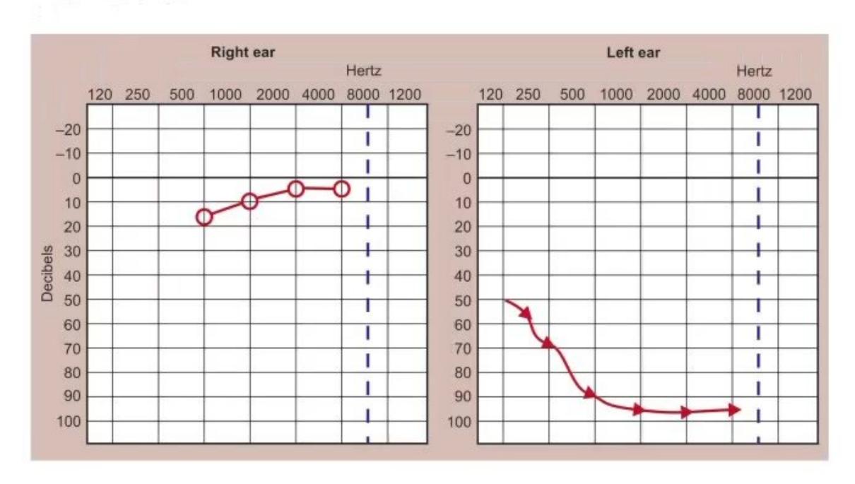 images/MNJ-P-OSCE 06. Audiometry, capnogram, spirometry_page_8_Figure_6.jpeg