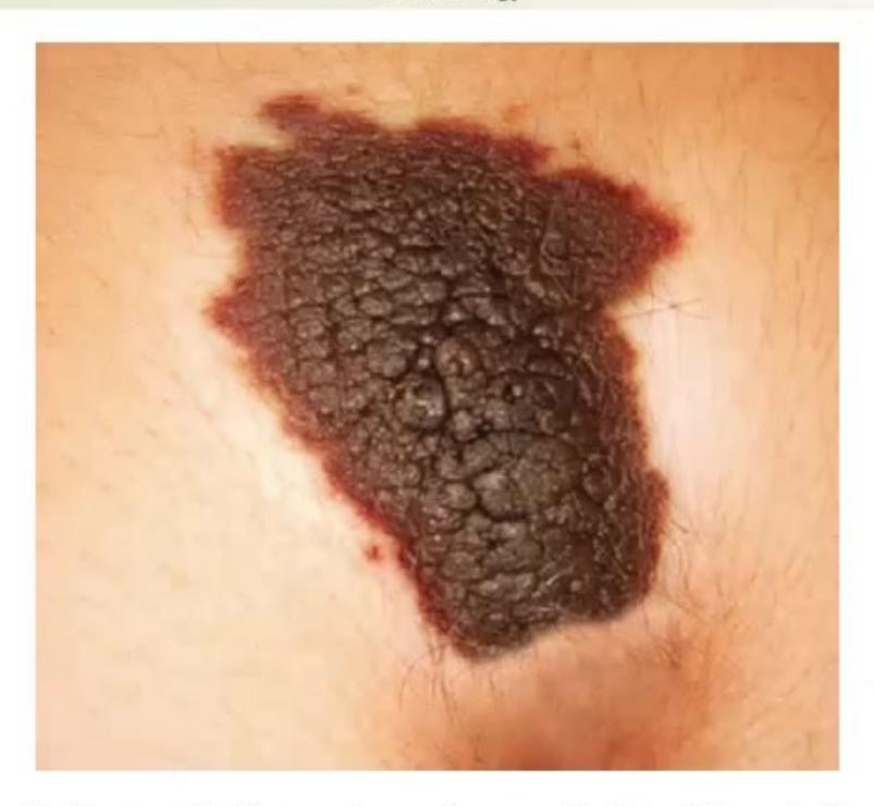images/MNJ-P-OSCE 14. Dermatology_page_10_Picture_1.jpeg