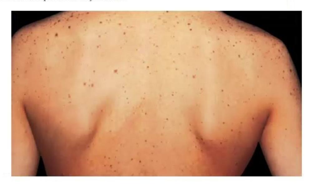 images/MNJ-P-OSCE 14. Dermatology_page_10_Picture_6.jpeg