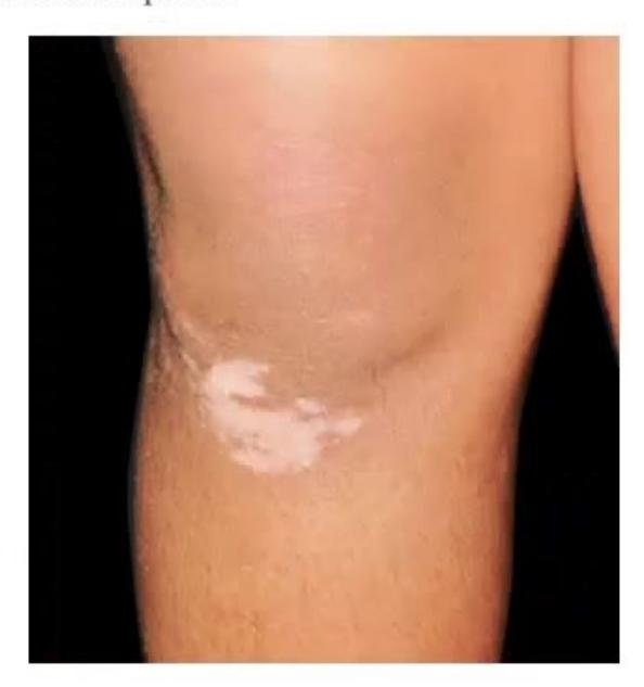 images/MNJ-P-OSCE 14. Dermatology_page_11_Picture_10.jpeg