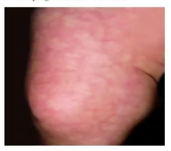 images/MNJ-P-OSCE 14. Dermatology_page_11_Picture_5.jpeg