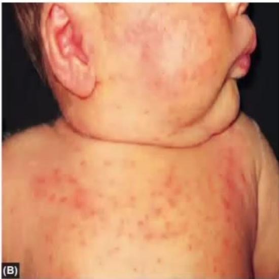 images/MNJ-P-OSCE 14. Dermatology_page_6_Picture_2.jpeg