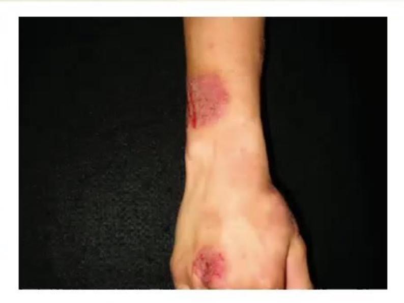 images/MNJ-P-OSCE 14. Dermatology_page_8_Picture_1.jpeg
