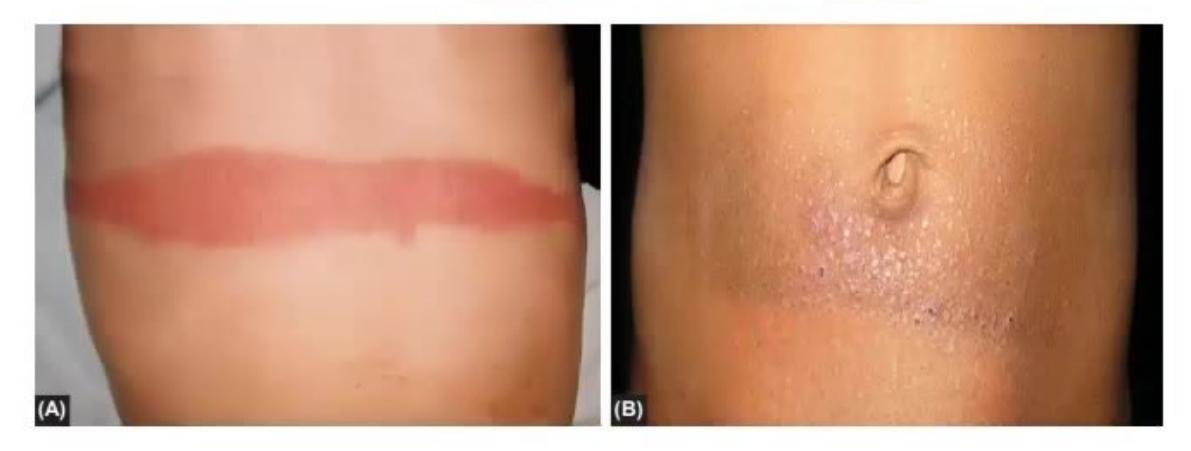 images/MNJ-P-OSCE 14. Dermatology_page_8_Picture_6.jpeg