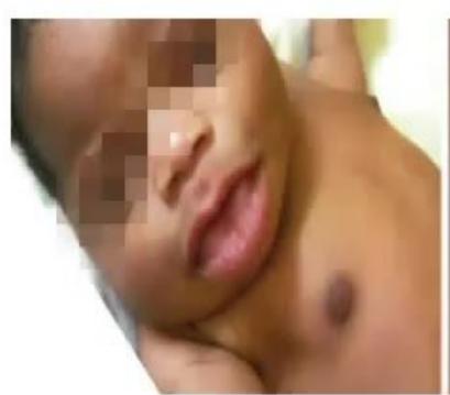 images/MNJ-P-OSCE 16. Genetic disorder_page_10_Picture_1.jpeg