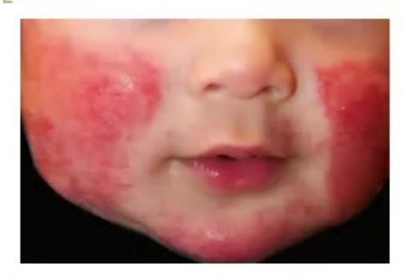 images/MNJ-P-OSCE 18. Immunodeficiency_page_2_Picture_2.jpeg