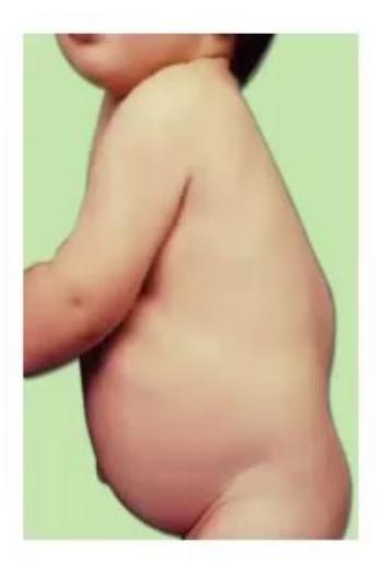images/MNJ-P-OSCE 19. Metabolic disorder_page_7_Picture_19.jpeg