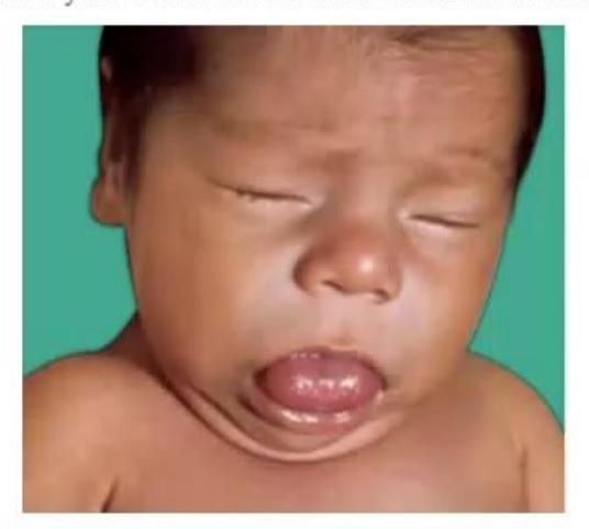 images/MNJ-P-OSCE 21. Neonatology_page_9_Picture_12.jpeg