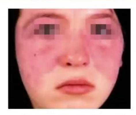 images/MNJ-P-OSCE 22. Connective tissue disorder_page_2_Picture_2.jpeg