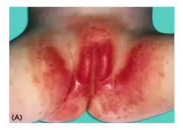 images/MNJ-P-OSCE 23. Infectious disease_page_12_Picture_2.jpeg