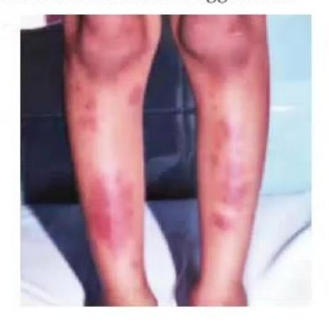 images/MNJ-P-OSCE 23. Infectious disease_page_13_Picture_20.jpeg