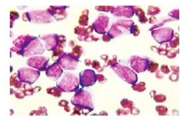 images/MNJ-P-OSCE 28. Hematoncology_page_1_Picture_8.jpeg
