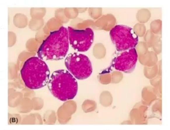 images/MNJ-P-OSCE 28. Hematoncology_page_3_Picture_8.jpeg