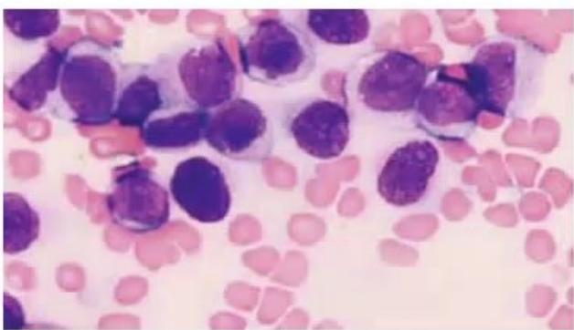 images/MNJ-P-OSCE 28. Hematoncology_page_4_Picture_3.jpeg