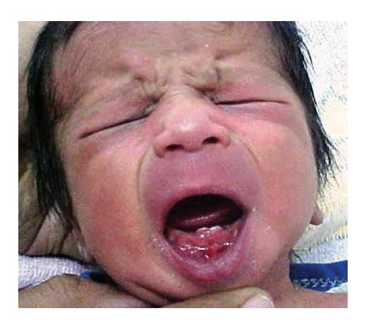 images/VVK-P-Osce 17. Neonatology_page_16_Picture_9.jpeg