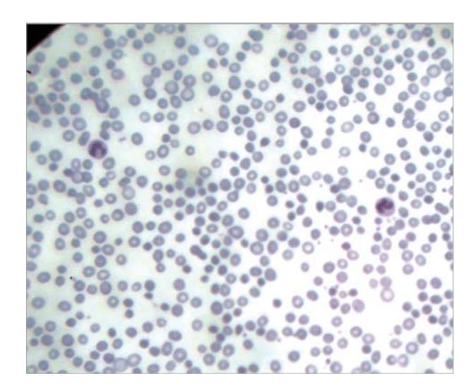 images/VVK-P-Osce 7. Hematology & Oncology_page_10_Picture_12.jpeg