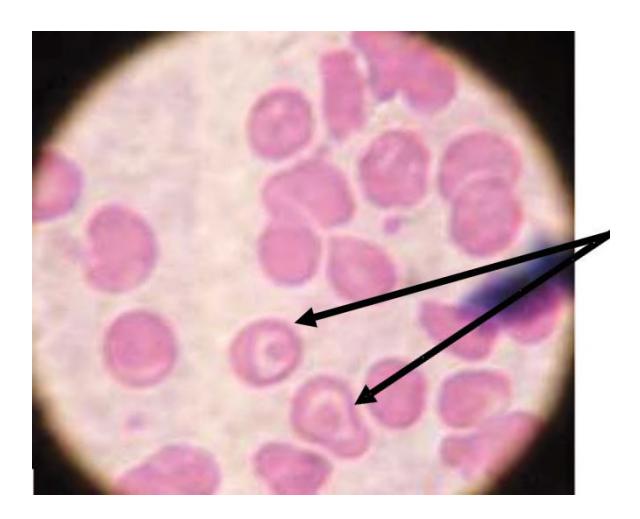 images/VVK-P-Osce 7. Hematology & Oncology_page_11_Picture_18.jpeg