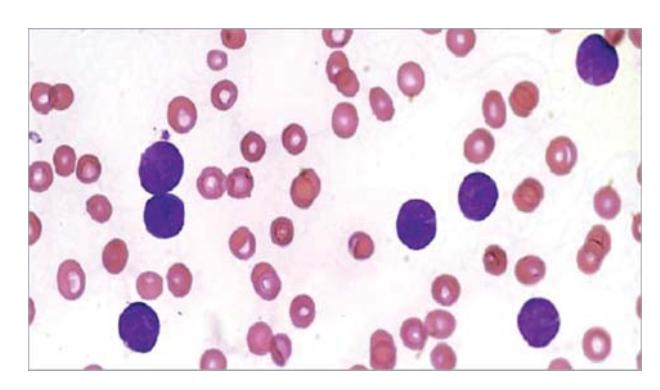 images/VVK-P-Osce 7. Hematology & Oncology_page_14_Picture_15.jpeg