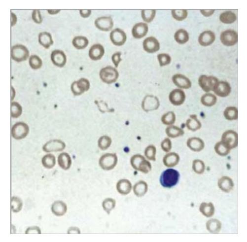 images/VVK-P-Osce 7. Hematology & Oncology_page_14_Picture_3.jpeg