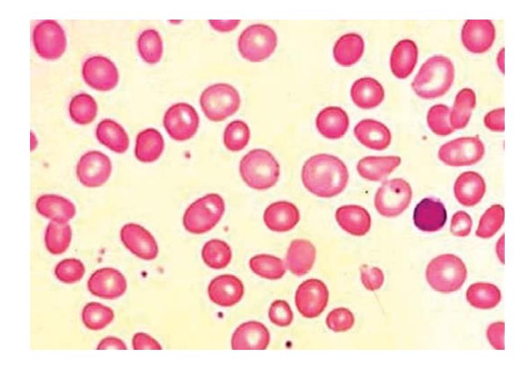images/VVK-P-Osce 7. Hematology & Oncology_page_15_Picture_3.jpeg
