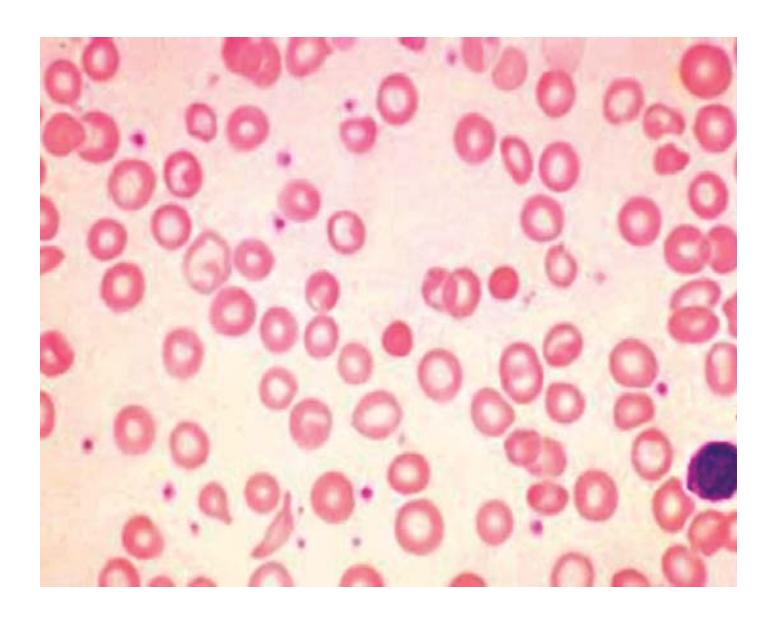 images/VVK-P-Osce 7. Hematology & Oncology_page_15_Picture_8.jpeg