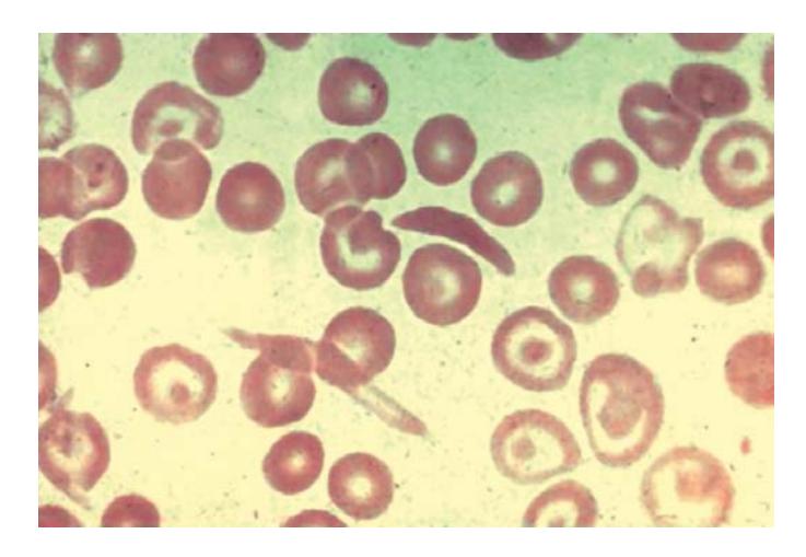 images/VVK-P-Osce 7. Hematology & Oncology_page_16_Picture_3.jpeg