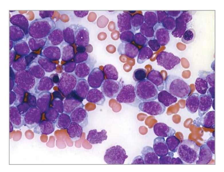 images/VVK-P-Osce 7. Hematology & Oncology_page_16_Picture_8.jpeg