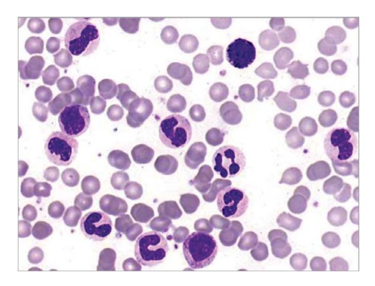 images/VVK-P-Osce 7. Hematology & Oncology_page_17_Picture_3.jpeg