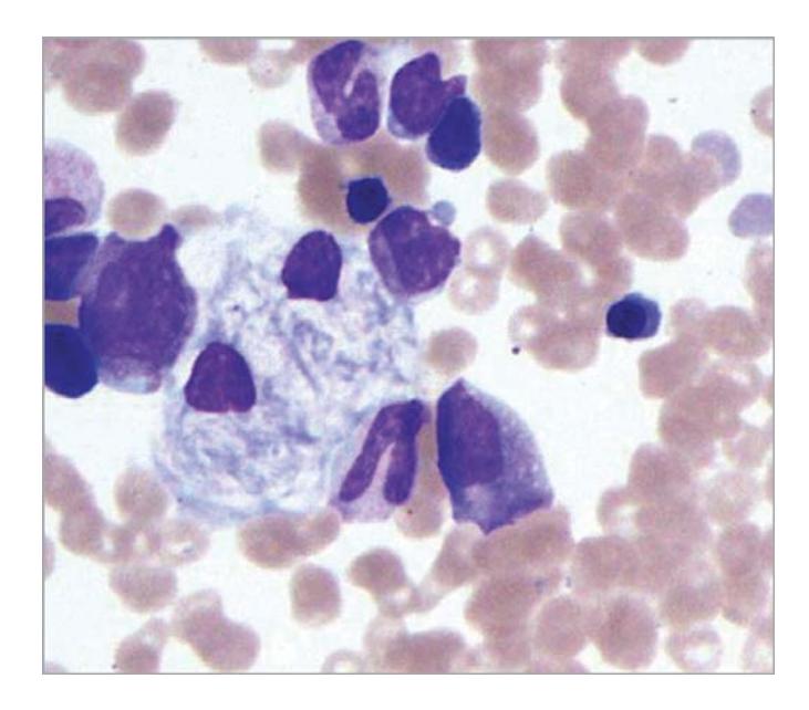 images/VVK-P-Osce 7. Hematology & Oncology_page_18_Picture_13.jpeg