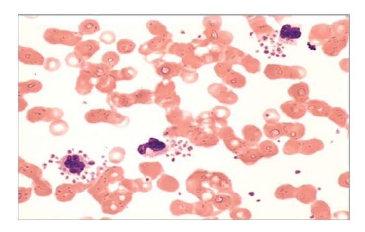images/VVK-P-Osce 7. Hematology & Oncology_page_19_Picture_3.jpeg