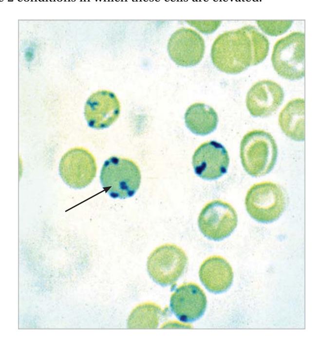images/VVK-P-Osce 7. Hematology & Oncology_page_3_Picture_18.jpeg