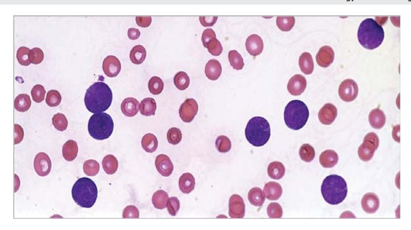 images/VVK-P-Osce 7. Hematology & Oncology_page_5_Picture_2.jpeg
