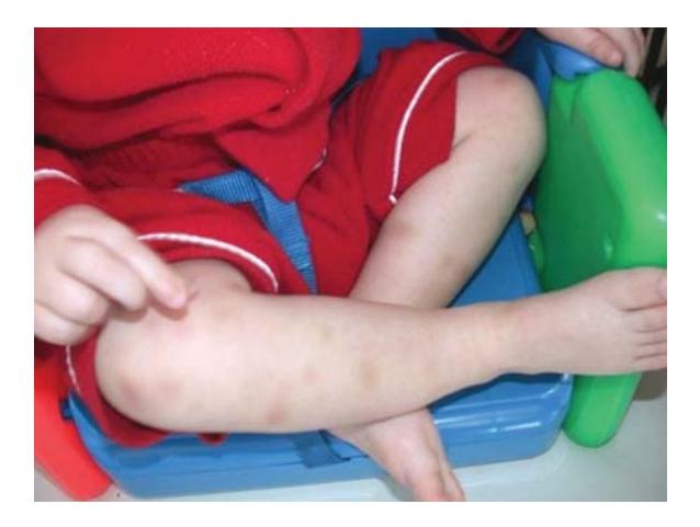 images/VVK-P-Osce 7. Hematology & Oncology_page_6_Picture_13.jpeg