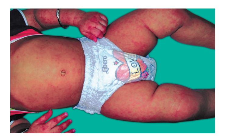 images/VVK-P-Osce 8. Infection_page_0_Picture_5.jpeg