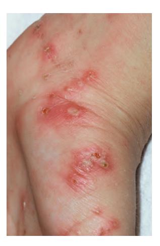 images/VVK-P-Osce 8. Infection_page_2_Picture_10.jpeg