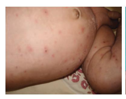 images/VVK-P-Osce 8. Infection_page_5_Picture_14.jpeg