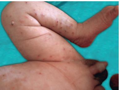images/VVK-P-Osce 8. Infection_page_5_Picture_15.jpeg