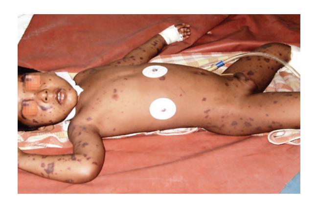 images/VVK-P-Osce 8. Infection_page_5_Picture_3.jpeg