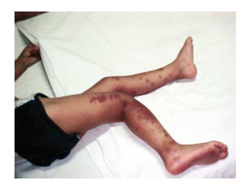 images/VVK-P-Osce 8. Infection_page_9_Picture_7.jpeg