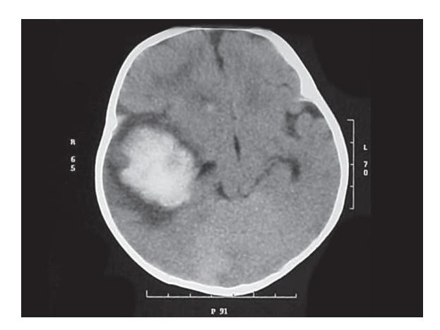 images/VVK-P-Osce 9. Neurology_page_9_Picture_14.jpeg